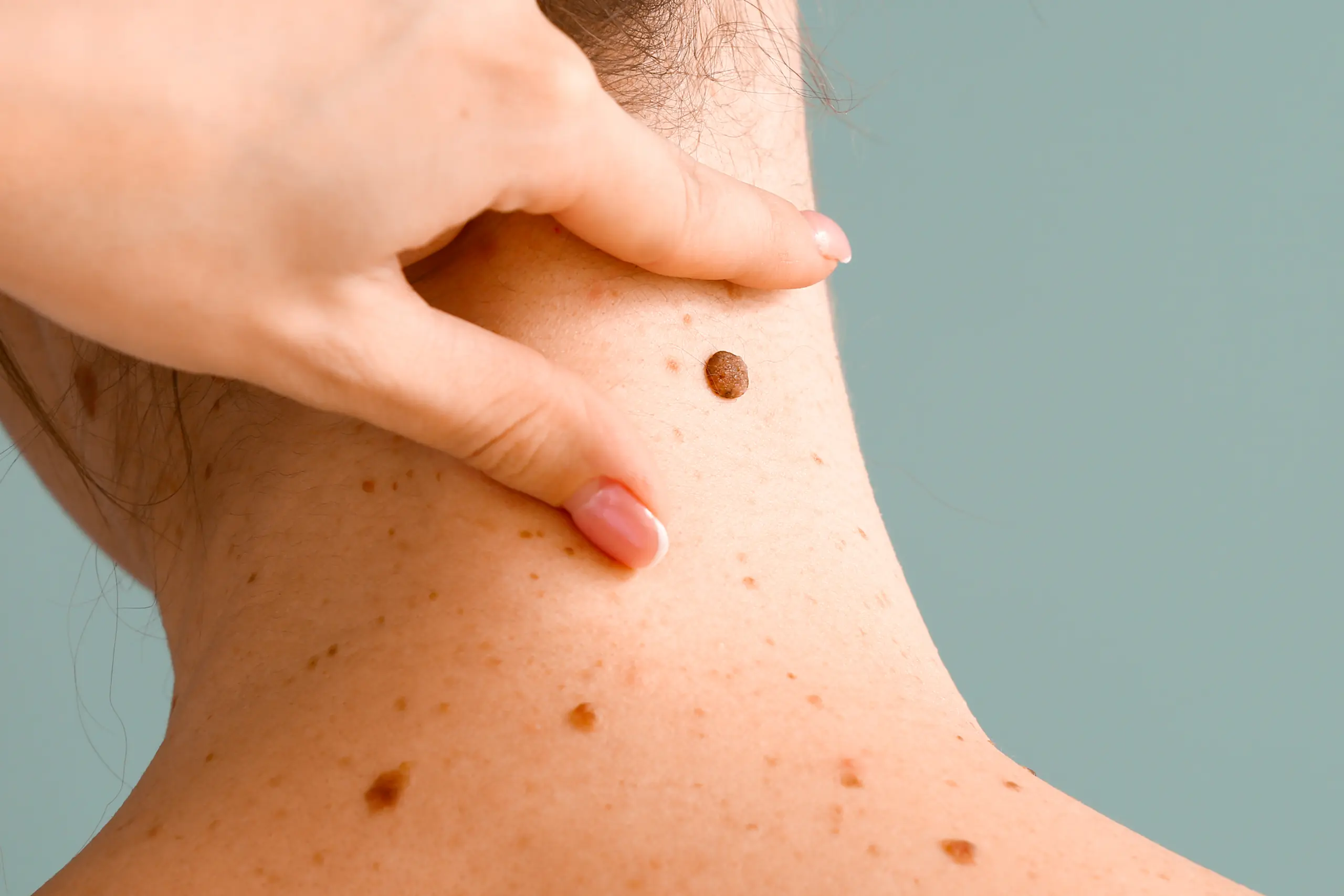 Grain de beauté inesthétique situé dans le cou d'une patiente