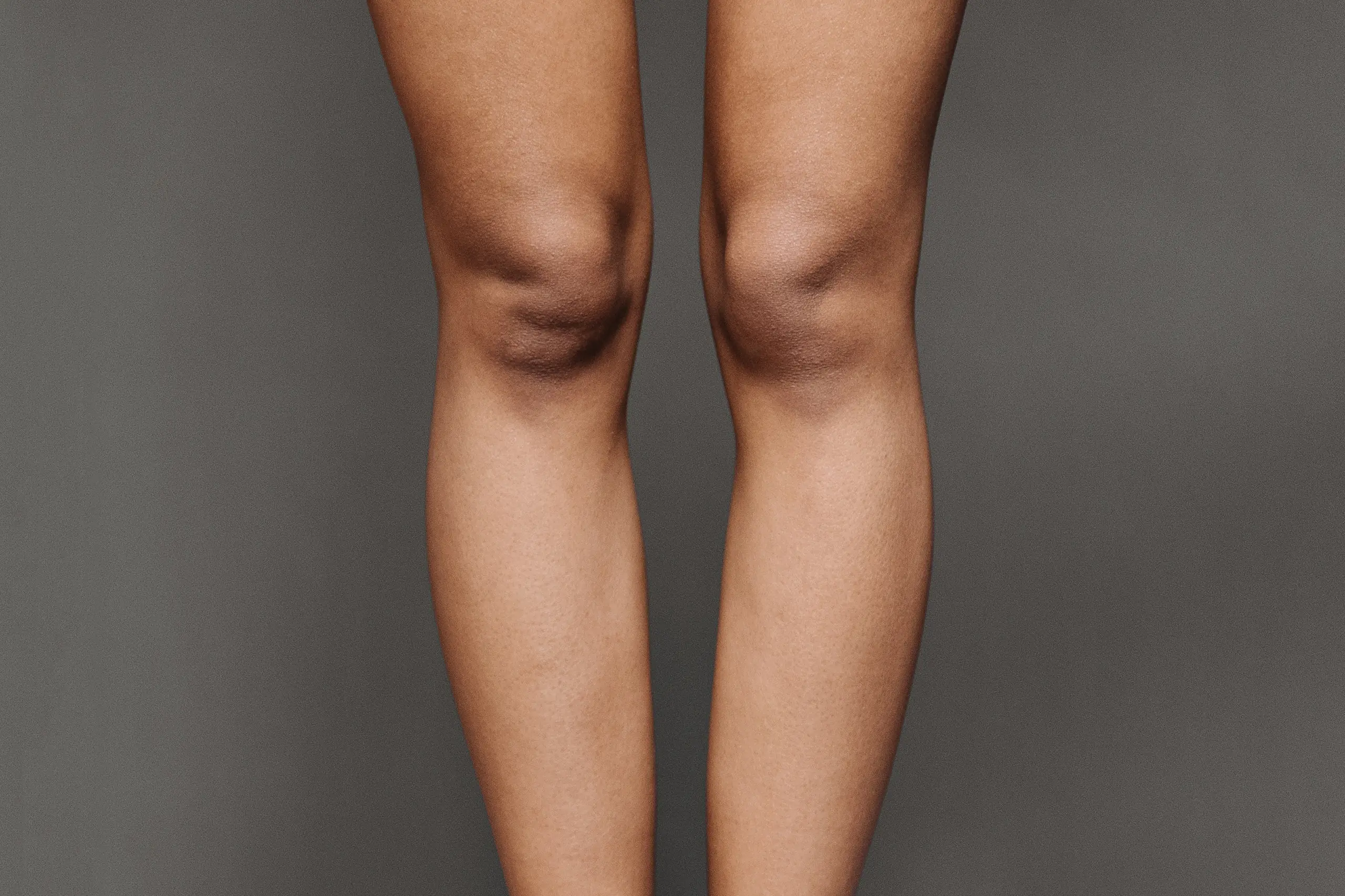 Cellulite des genoux| Causes et traitements esthétiques | Anthèse ...