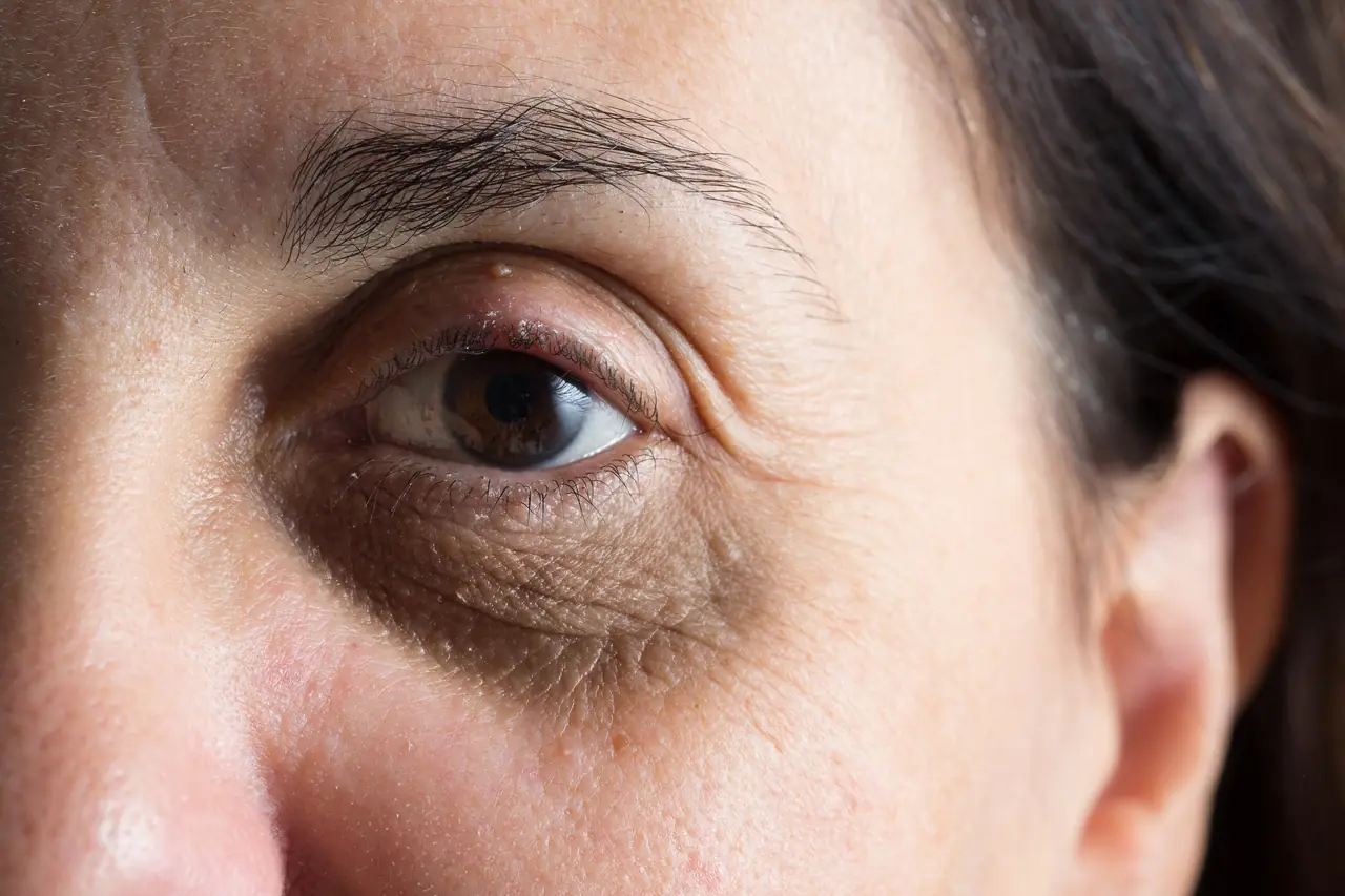 Cernes noirs : comment faire disparaitre le contour des yeux noir ?
