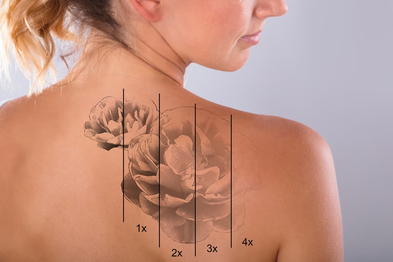 Image représentant le nombre de séances nécessaires pour un détatouage complet