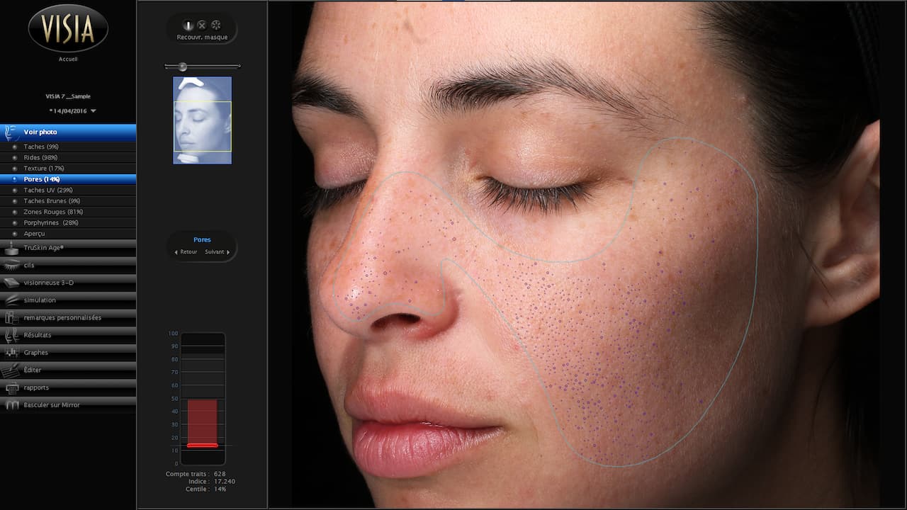 Vue de l'écran d'analyse des pores du diagnostic de peau du Visia 7 au sein d'Anthèse Bordeaux