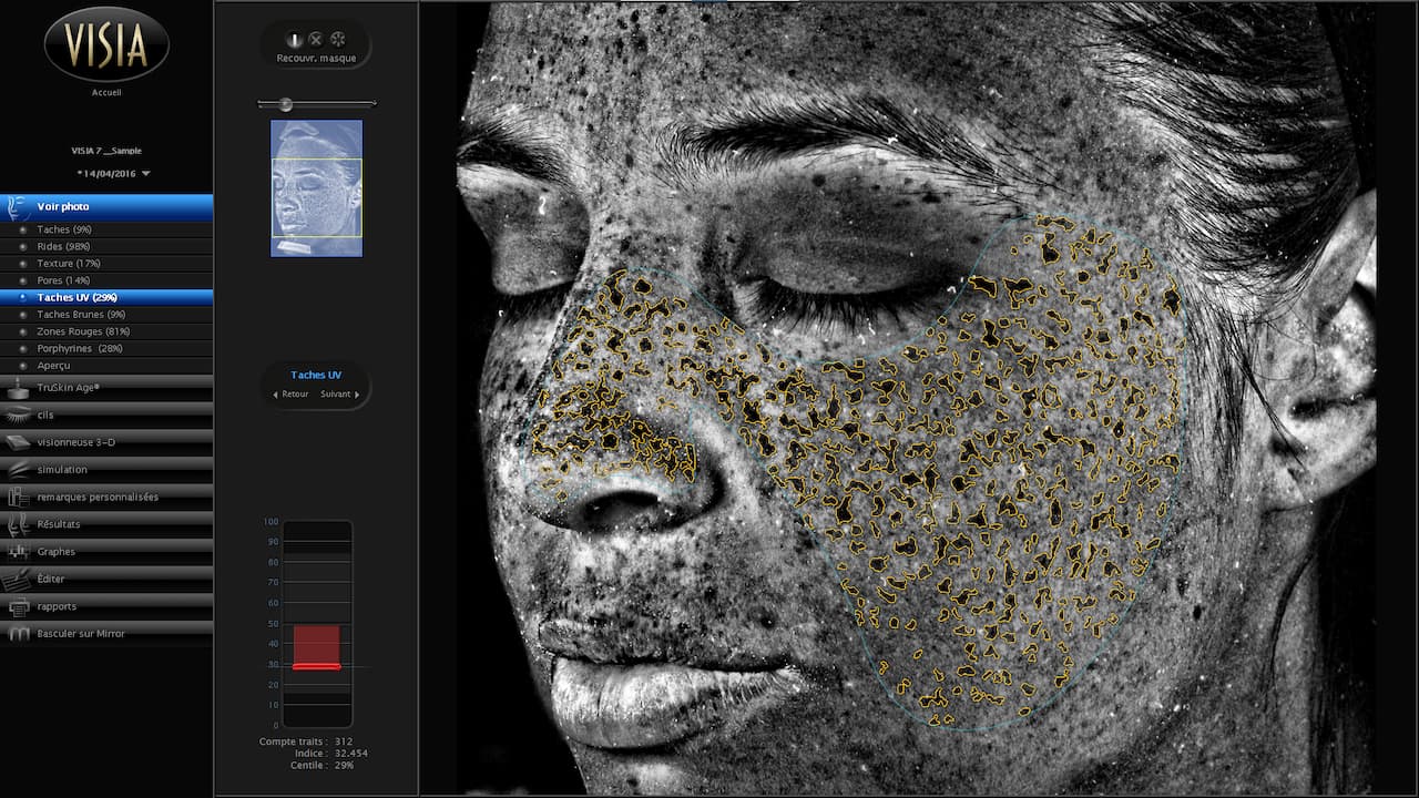 Vue de l'écran d'analyse des taches uv du diagnostic de peau du Visia 7 au sein d'Anthèse Bordeaux