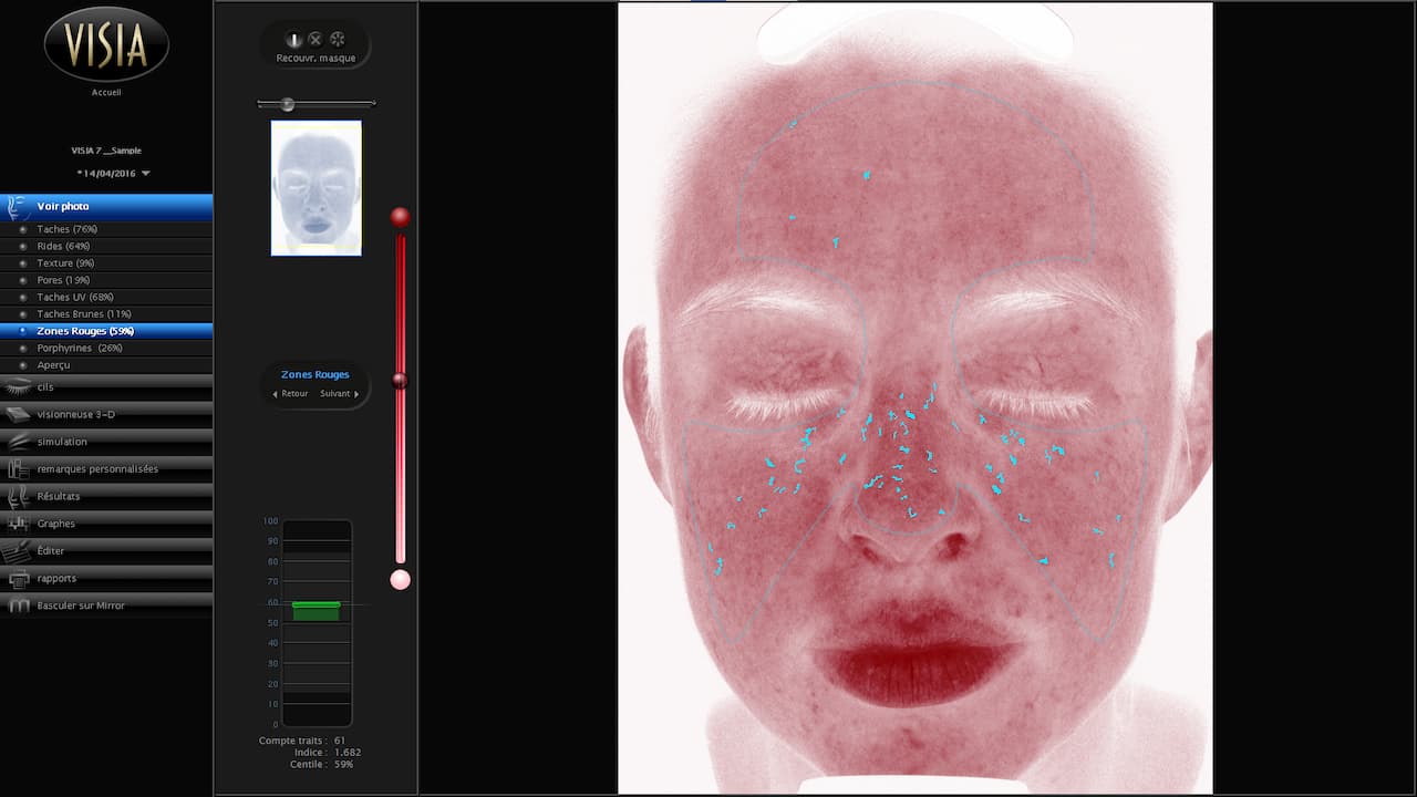 Vue de l'écran d'analyse des zones rouges du diagnostic de peau du Visia 7 au sein d'Anthèse Bordeaux
