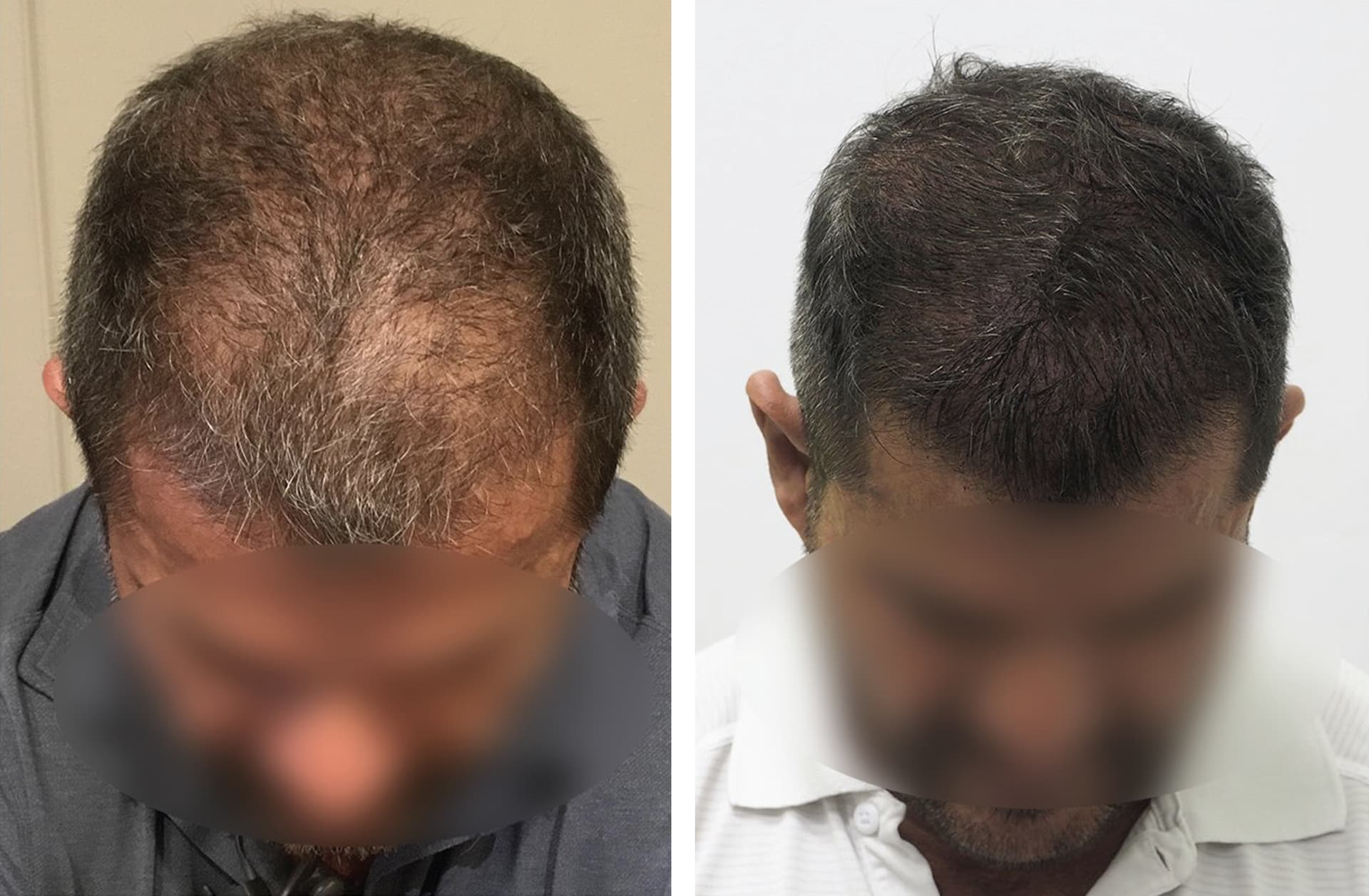 greffe-cheveux-robotisee-resultat-avant-apres-1 Greffe de cheveux robotisée Artas iX - Exemple résultats avant après 1