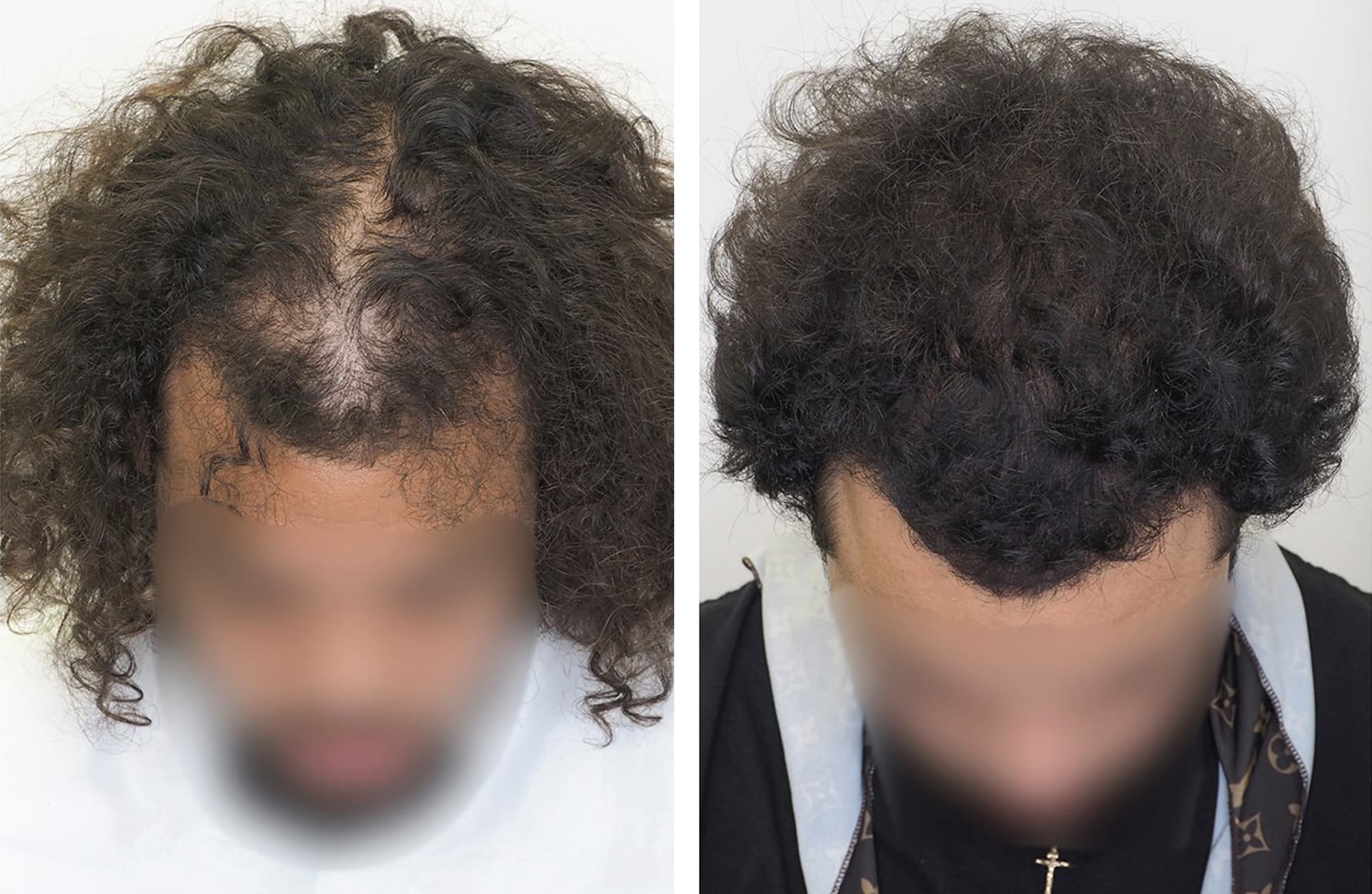 greffe-cheveux-robotisee-resultat-avant-apres-2 Greffe de cheveux robotisée Artas iX - Exemple résultats avant après 2